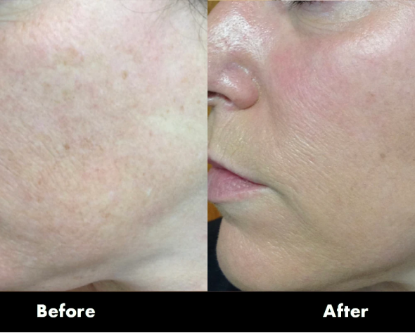 lutronic-hollywood-spectra