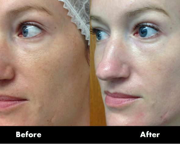 lutronic-hollywood-spectra