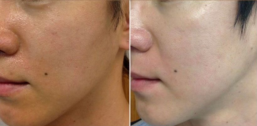 Microneedling
