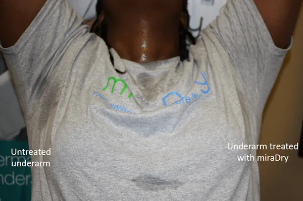 miraDry 4