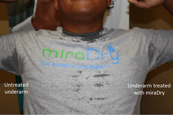 miraDry 6