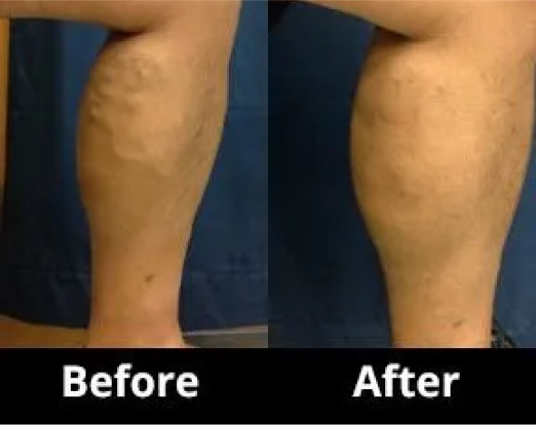 Endovenous Thermal Ablation