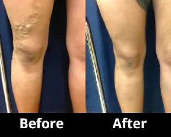 Endovenous Thermal Ablation