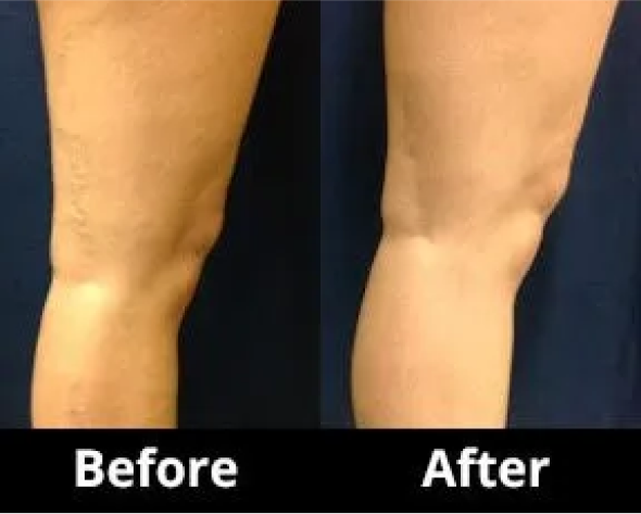 Ultrasound Guided Sclerotherapy