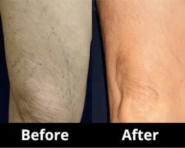 Visual Sclerotherapy