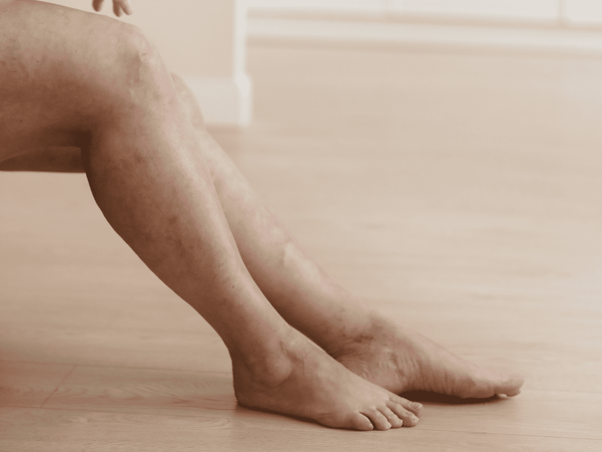 The Role of Genetics in Spider Veins and Varicose Veins