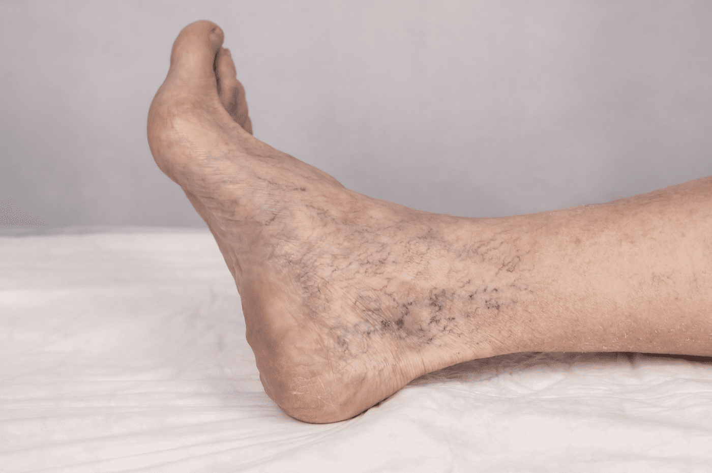 When Chronic Venous Insufficiency Causes Skin Breakdowns