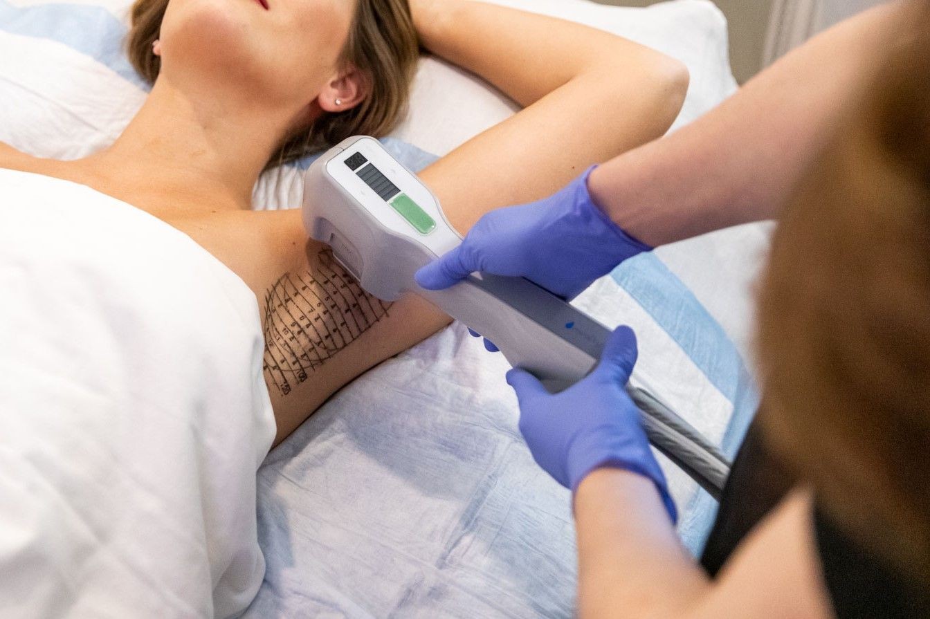 Why MiraDry Is Honolulu’s Top Self-Care Treatment