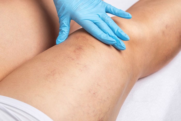 Comparing Ultrasound-Guided and Visual Sclerotherapy