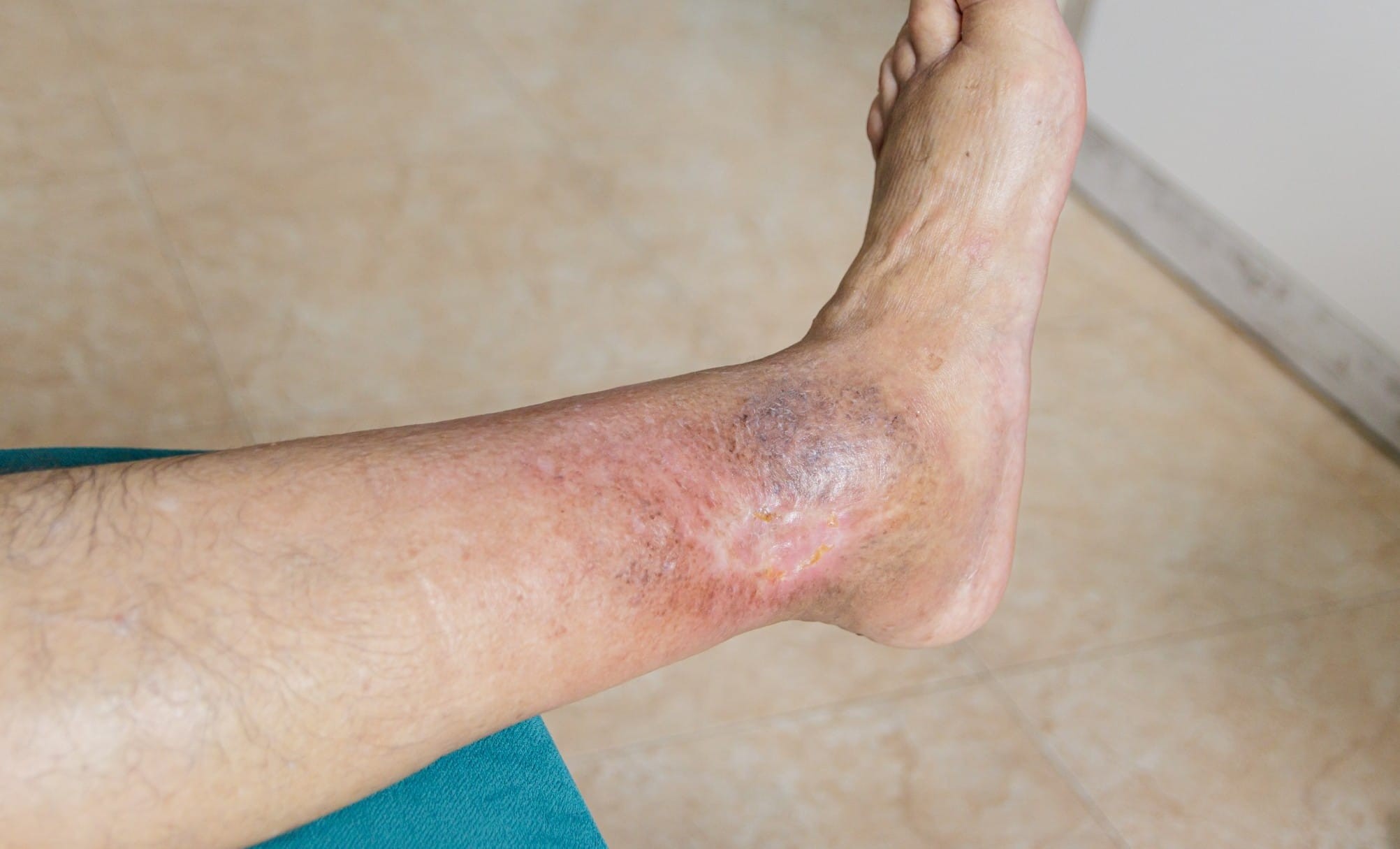 How Proper Care Prevents Infection in Venous Wounds