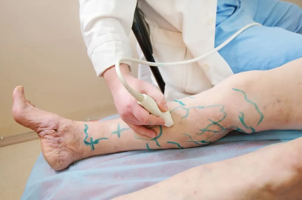 The Power of Ultrasound Guided Sclerotherapy in Vein Care
