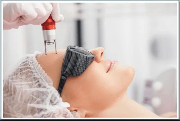 Laser Therapy Treatment for Varicose Veins